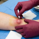 Medical professional performing minor surgery on inflamed skin abscess